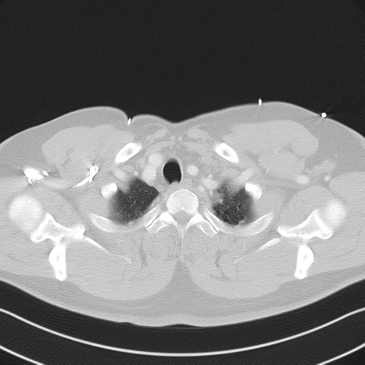File:Aortic dissection (Radiopaedia 50763-56234 Axial lung window 12).png