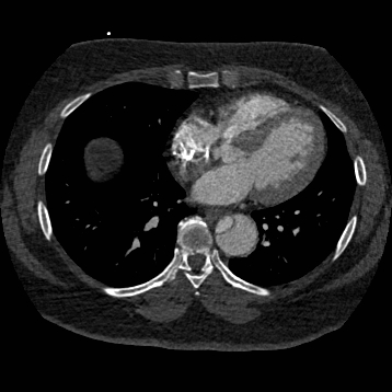 Aortic dissection (Radiopaedia 57969-64959 A 195).jpg