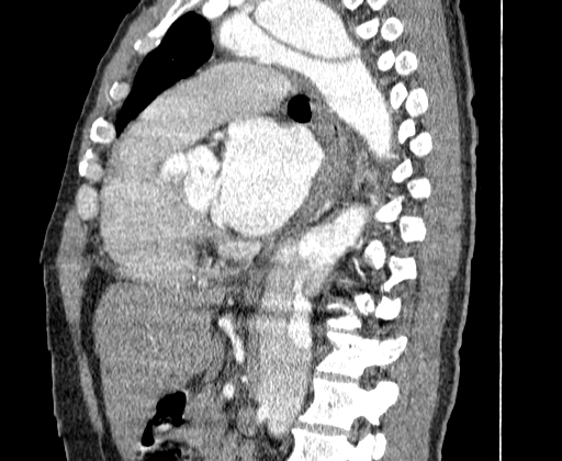 File:Aortic dissection - Stanford A -DeBakey I (Radiopaedia 28339-28587 C 40).jpg