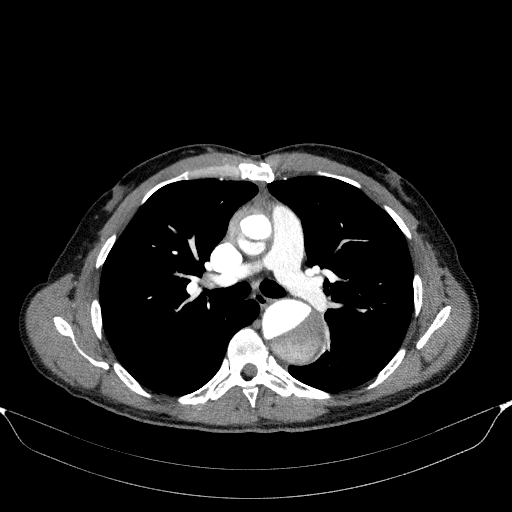 Aortic dissection - Stanford type A (Radiopaedia 83418-98500 A 28).jpg