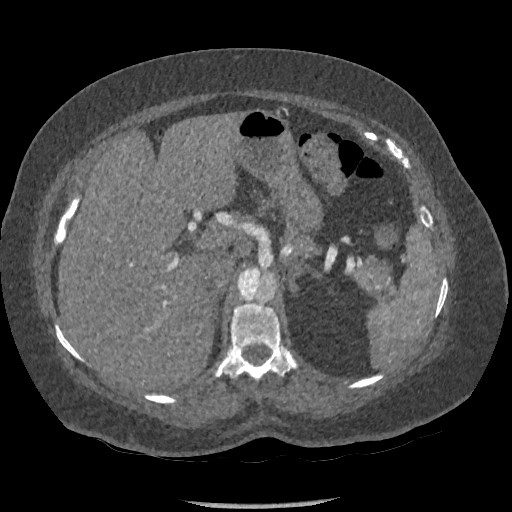 Aortic dissection - Stanford type B (Radiopaedia 88281-104910 A 101).jpg