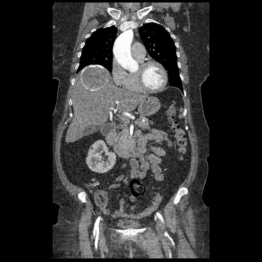 File:Aortic dissection - Stanford type B (Radiopaedia 88281-104910 B 19).jpg