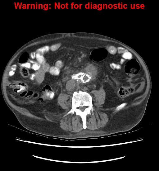 Aortic graft infection (Radiopaedia 44979-48907 Axial non-contrast 57).jpg