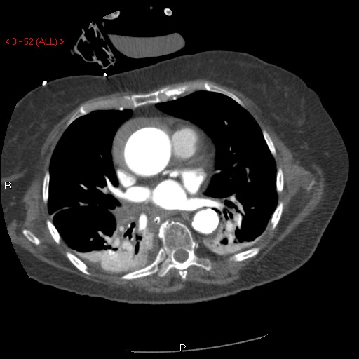 Aortic intramural hematoma (Radiopaedia 27746-28001 A 52).jpg