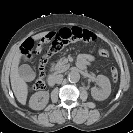Aortic intramural hematoma (Radiopaedia 31139-31838 Axial non-contrast 61).jpg