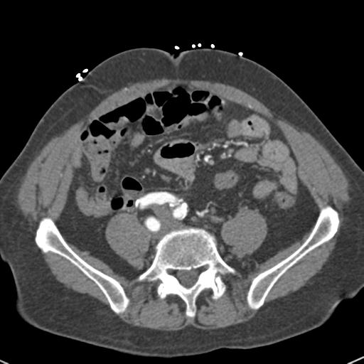 Aortic intramural hematoma (Radiopaedia 31139-31838 B 128).jpg