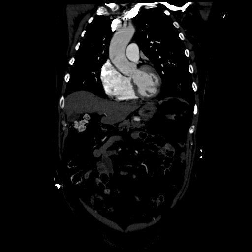 Aortic intramural hematoma (Radiopaedia 34260-35540 C 29).png