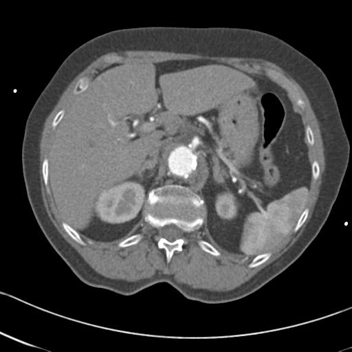 Aortic intramural hematoma from penetrating atherosclerotic ulcer (Radiopaedia 31137-31836 A 83).jpg