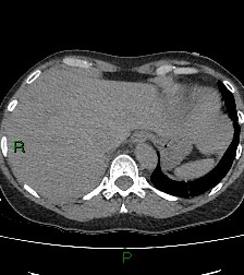 File:Aortic valve endocarditis (Radiopaedia 87209-103485 Axial non-contrast 86).jpg