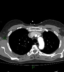 File:Aortic valve endocarditis (Radiopaedia 87209-103485 C 24).jpg