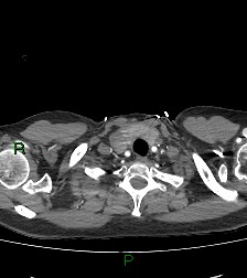 Aortic valve endocarditis (Radiopaedia 87209-103485 C 6).jpg