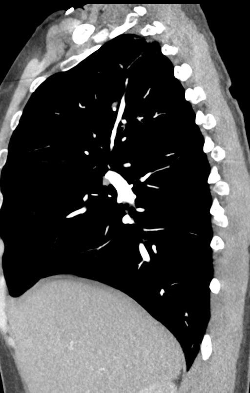 Aortic valve non-coronary cusp thrombus (Radiopaedia 55661-62189 C+ arterial phase 47).png