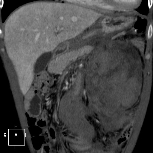 File:Aorto-left renal vein fistula (Radiopaedia 45534-49628 B 11).jpg