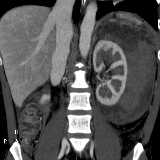 Aorto-left renal vein fistula (Radiopaedia 45534-49628 B 40).jpg