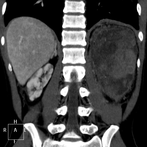 File:Aorto-left renal vein fistula (Radiopaedia 45534-49628 B 55).jpg
