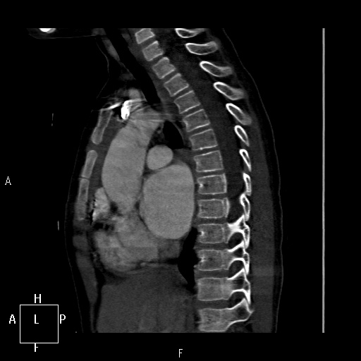 File:Aortopulmonary septal defect (Radiopaedia 41990-45013 Sagittal C+ CTPA 30).jpg