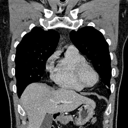 Apical lung mass mimic - neurogenic tumor (Radiopaedia 59918-67521 B 45).jpg