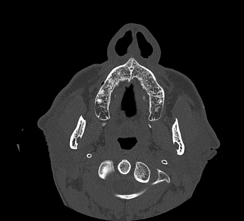 Aplastic maxillary sinuses (Radiopaedia 60030-67561 Axial non-contrast 7).jpg