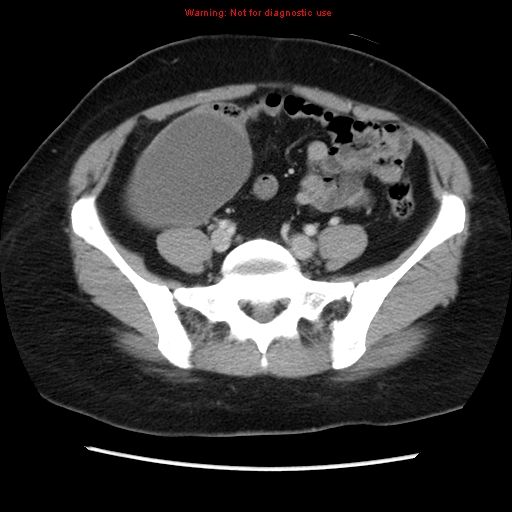 File:Appendiceal mucinous cystadenoma (Radiopaedia 8263-9111 Axial liver window 58).jpg