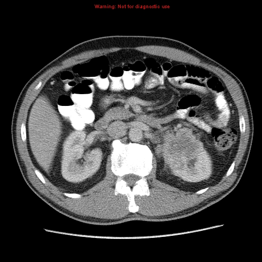 File:Appendicitis and renal cell carcinoma (Radiopaedia 17063-16760 A 21).jpg
