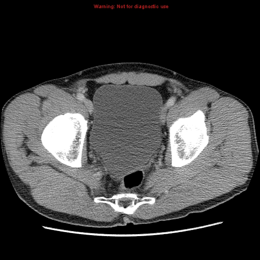 File:Appendicitis and renal cell carcinoma (Radiopaedia 17063-16760 A 51).jpg