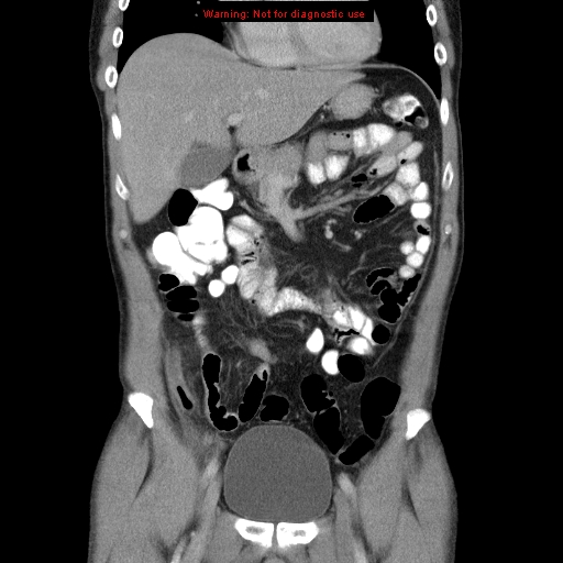 File:Appendicitis and renal cell carcinoma (Radiopaedia 17063-16760 B 11).jpg