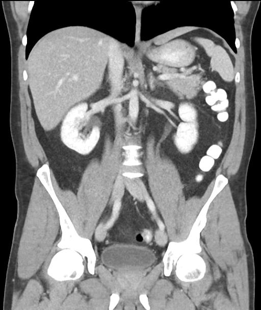 Appendicitis with cecal bar sign (Radiopaedia 31878-32830 A 35).jpg