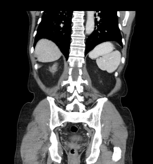 File:Appendicitis with localized perforation and abscess formation (Radiopaedia 49035-54130 B 37).jpg