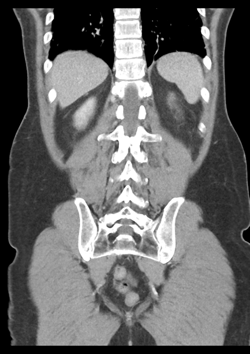 Appendicitis with thickening of the terminal ileum (Radiopaedia 42432-45550 B 46).png