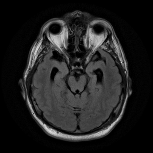 File:Aqueduct stenosis with corpus callosum hypoattenuation post shunting (Radiopaedia 37212-38969 Axial FLAIR 8).png