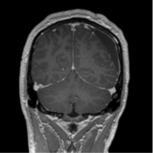 Arachnoid cyst with subdural hematoma (Radiopaedia 85892-101743 Coronal T1 C+ 23).png