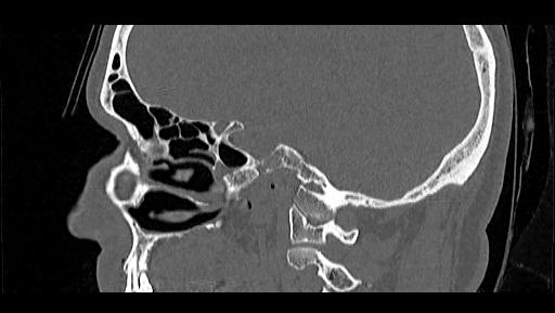 File:Arcuate foramen (Radiopaedia 89833-106944 Sagittal bone window 31).jpg