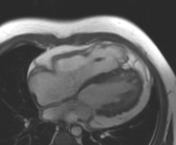 File:Arrhythmogenic right ventricular cardiomyopathy (Radiopaedia 69431-79307 4ch cine 46).jpg