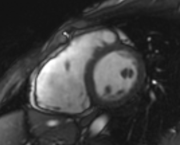 File:Arrhythmogenic right ventricular cardiomyopathy (Radiopaedia 69564-79464 short axis cine 180).jpg