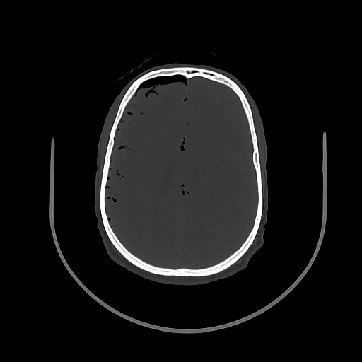 Arrow injury to the brain (Radiopaedia 72101-82607 Axial bone window 78).jpg
