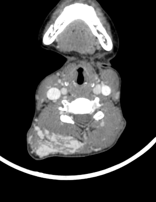 Arteriovenous malformation of the neck (Radiopaedia 53935-60062 B 27).jpg