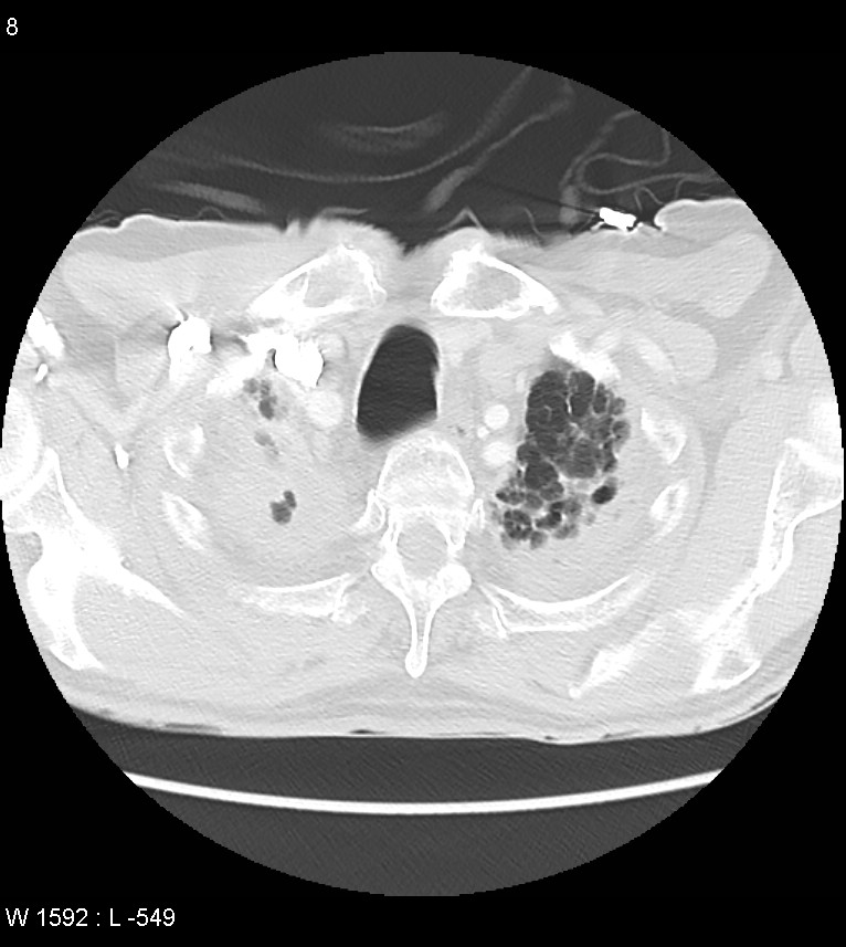 Asbestos related lung and pleural disease (Radiopaedia 14377-14301 A 5).jpg