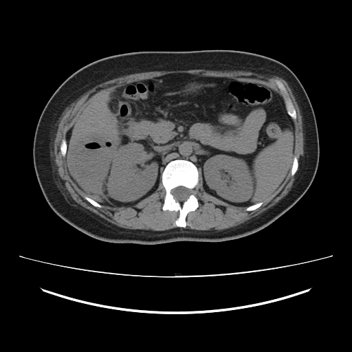 File:Ascending retrocecal appendicitis with liver abscesses (Radiopaedia 60066-67615 Axial non-contrast 32).jpg