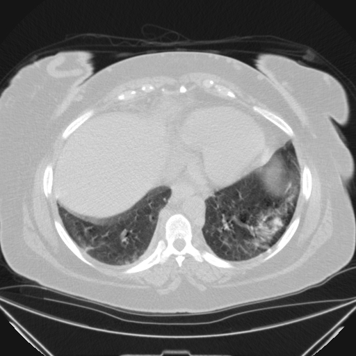 Aspergilloma (Radiopaedia 39611-41932 Axial lung window 101).jpg