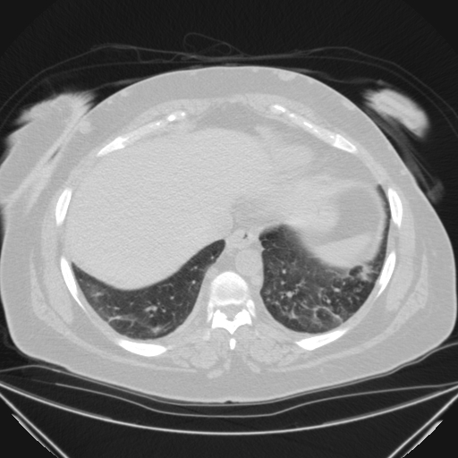 Aspergilloma (Radiopaedia 39611-41932 Axial lung window 109).jpg