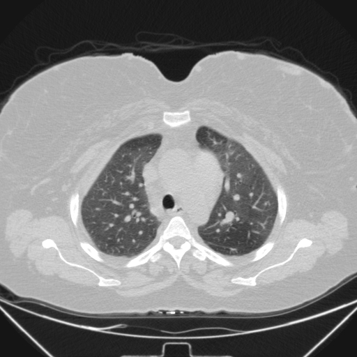 Aspergilloma (Radiopaedia 39611-41932 Axial lung window 35).jpg