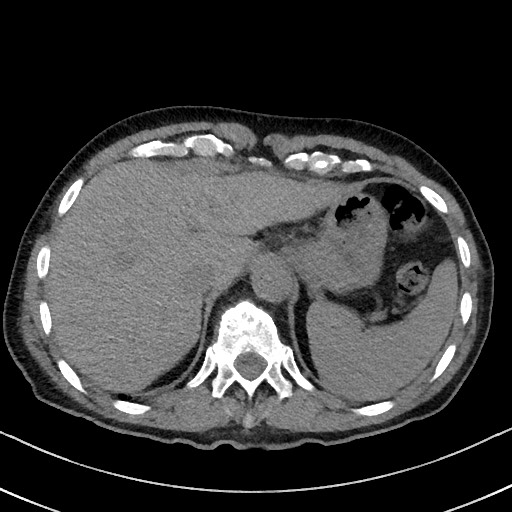 Aspergilloma on background pulmonary fibrosis (Radiopaedia 60942-68757 Axial non-contrast 53).jpg