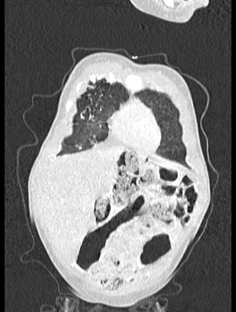 Asplenia syndrome (Radiopaedia 73083-83792 Coronal lung window 14).jpg