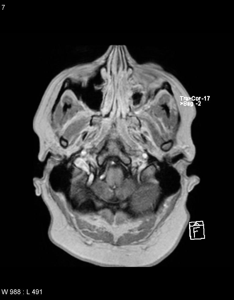 Astroblastoma (Radiopaedia 39792-42217 Axial T1 C+ 6).jpg