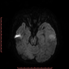 Astroblastoma (Radiopaedia 74287-85162 Axial DWI 34).jpg