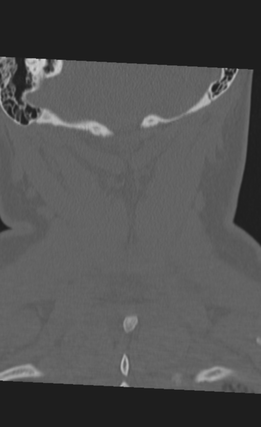 Atlanto-occipital dissociation (Radiopaedia 33848-35013 Coronal bone window 48).png
