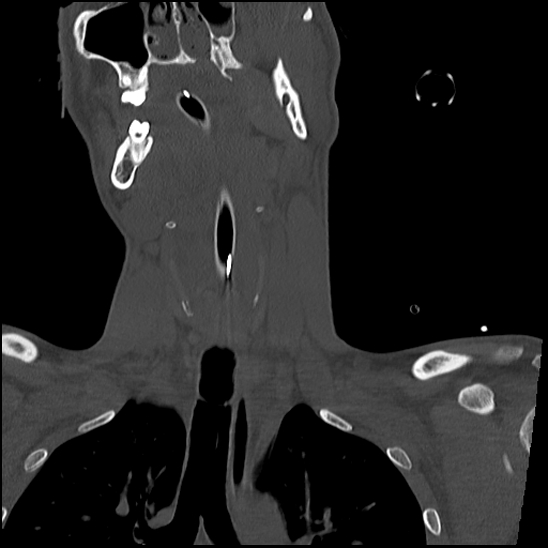 Atlanto-occipital dissociation (Traynelis type 1), C2 teardrop fracture, C6-7 facet joint dislocation (Radiopaedia 87655-104061 Coronal bone window 25).jpg