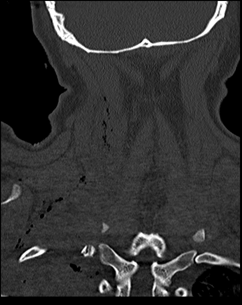 Atlanto-occipital dissociation - Traynelis type 1 (Radiopaedia 87570-103948 Coronal bone window 48).jpg