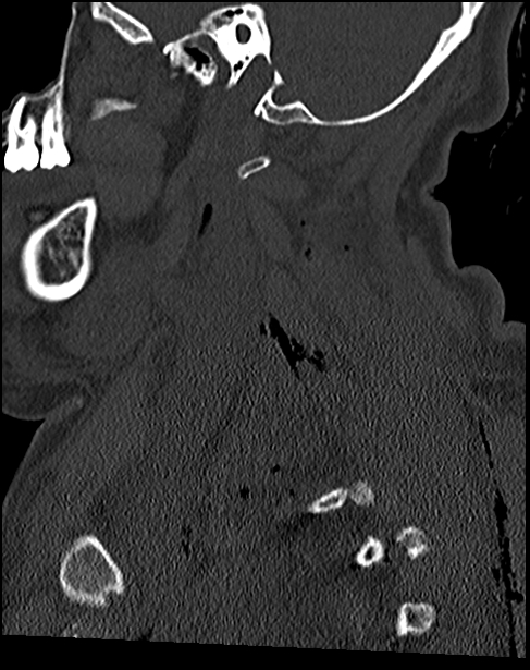 Atlanto-occipital dissociation - Traynelis type 1 (Radiopaedia 87570-103948 Sagittal bone window 29).jpg