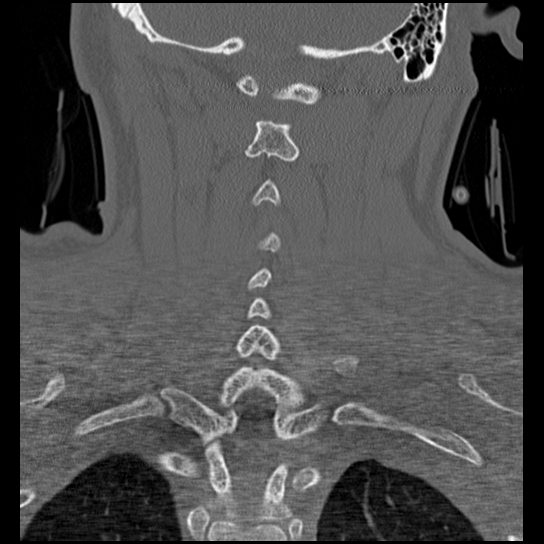 Atlanto-occipital dissociation injury (Radiopaedia 29274-29698 Coronal bone window 13).png